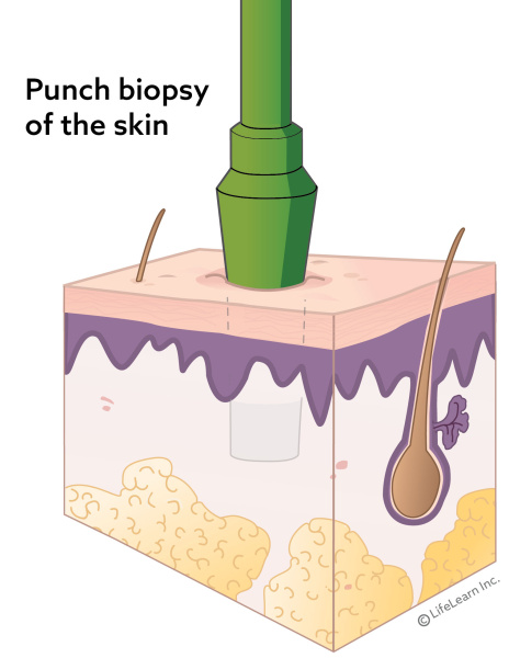skin_layers_punch_biopsy_2018_002-01
