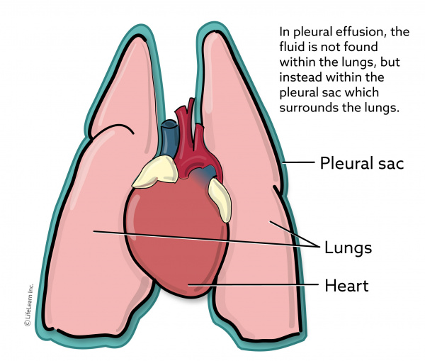 pleural_sac__2018-01 pleural_sac__2018-01