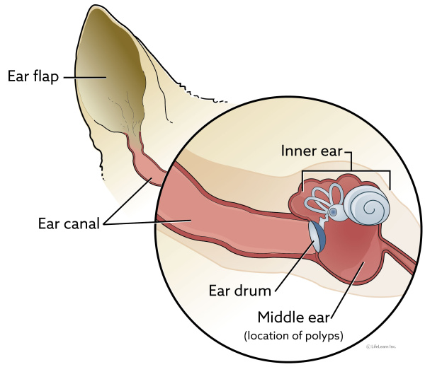 earcanal_nasopharyngeal_polyps_2018-01