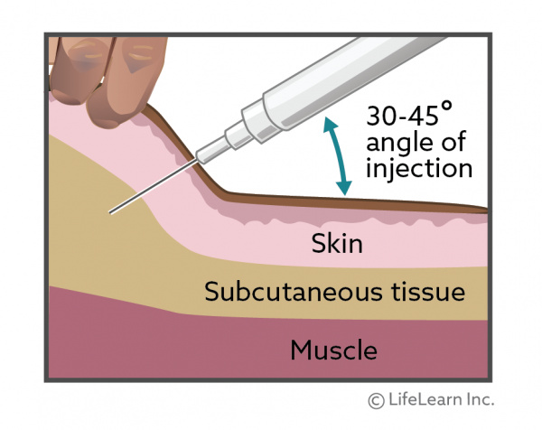 Illustration shows how the needle should be inserted at a 35-40 degree angle from the skin. The needles inserts through the upper skin layer and into the subcutaneous tissue below. It is not inserted far enough to reach the muscle.